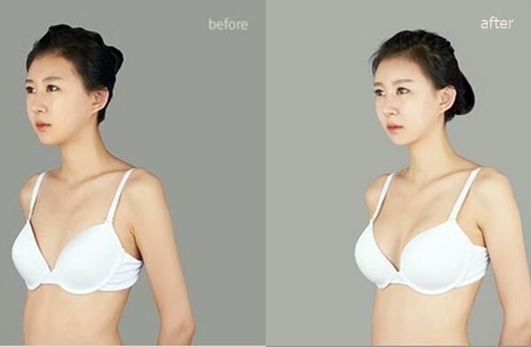 pred in po plastičnem povečanju prsi