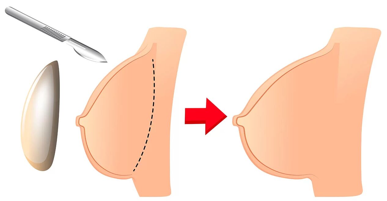 Povečanje prsi z vsadkom
