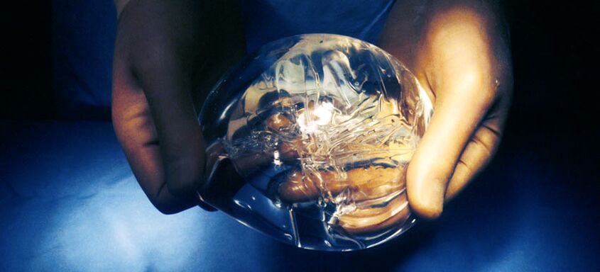 Silikonska endoproteza